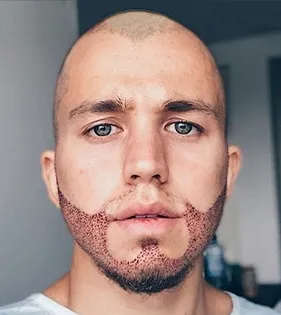 Hombre un día después de un trasplante de barba, con los injertos recientes visibles en mejillas, mandíbula y bigote
