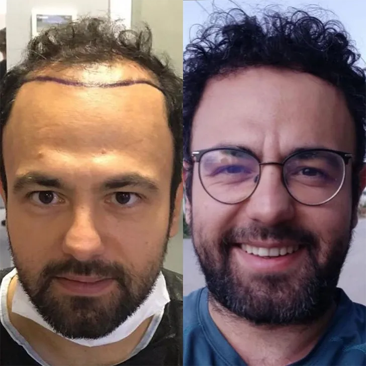 Hombre con la nueva línea frontal dibujada en la frente antes de la cirugía, y después con cabello rizado crecido sobre esa línea