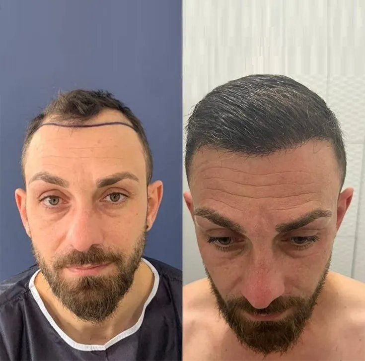 Hombre con la línea frontal marcada y la zona frontal débil antes de la cirugía, y después con más cabello al frente