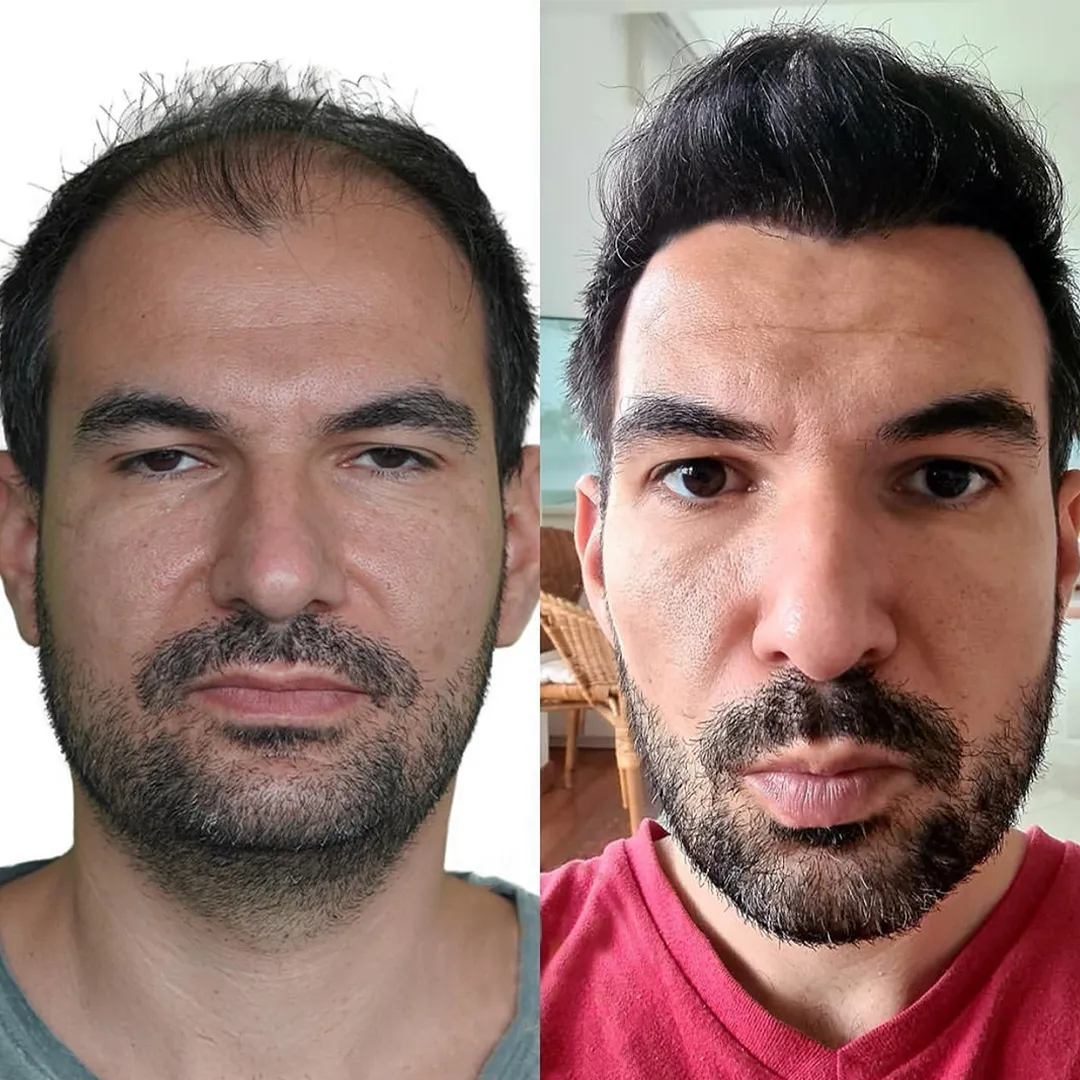 Paciente de Hair in Mexico antes y después de un trasplante capilar