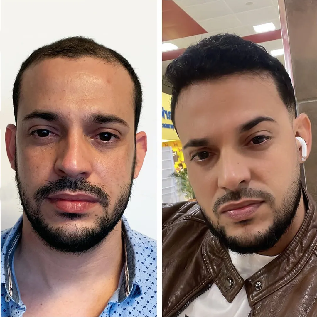 Paciente de Hair in Mexico antes y después de un trasplante capilar en la línea frontal