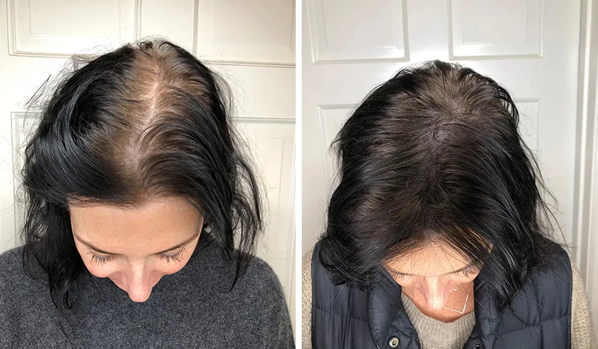 Paciente mujer antes y después de un trasplante capilar