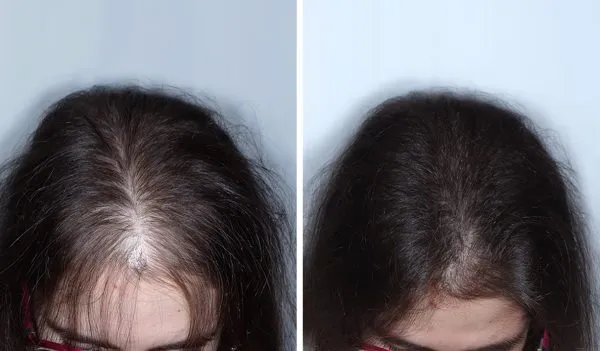 Coronilla y raya de una mujer con el cuero cabelludo visible, y después con el cuero cabelludo mucho menos visible