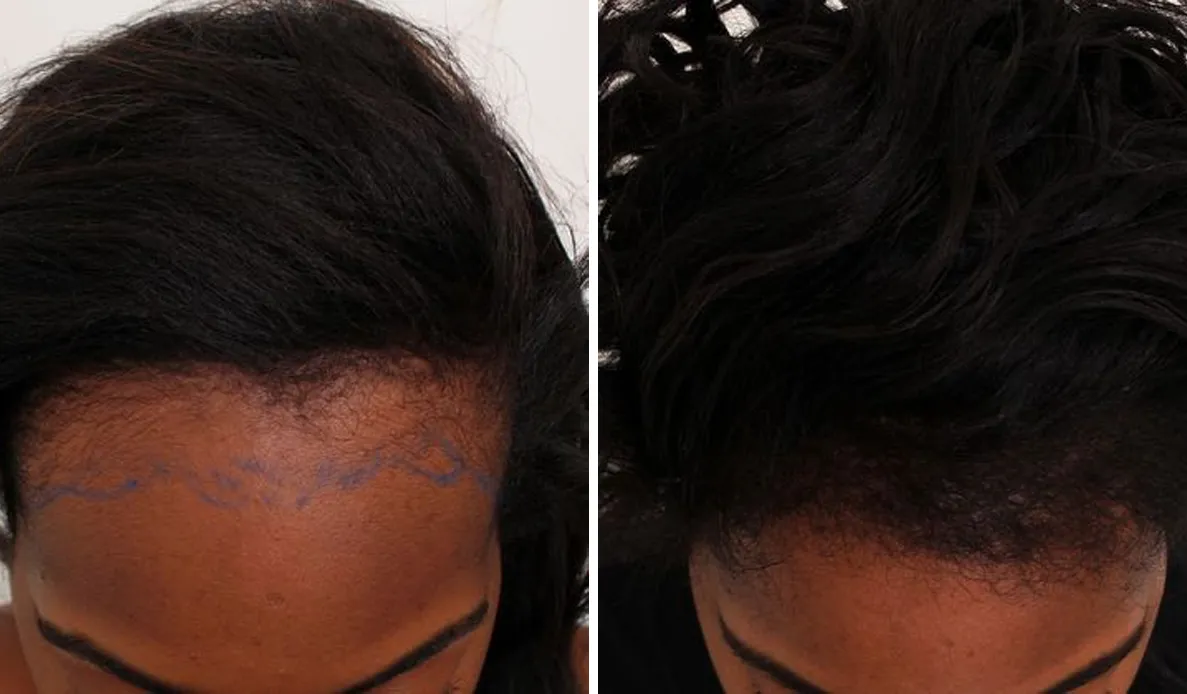 Línea del cabello de una mujer con la nueva línea dibujada con marcador antes de la cirugía, y después la misma zona poblada