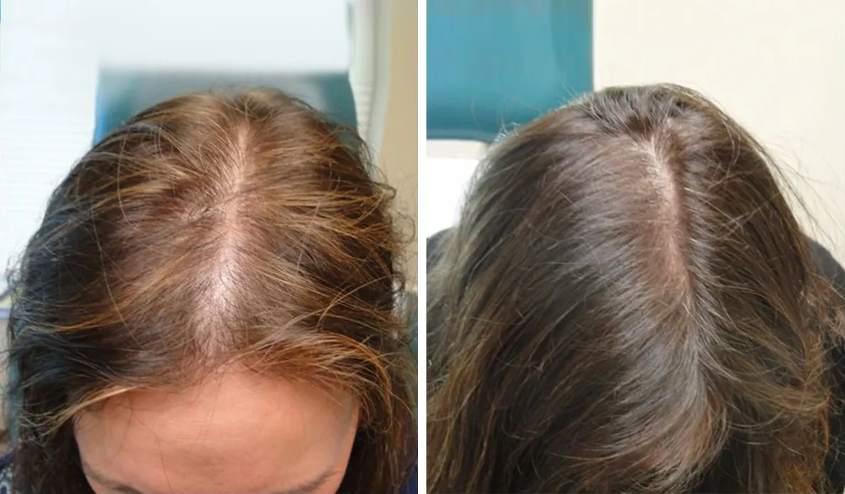 Raya ancha de una mujer con cabello delgado a los lados, y después una raya más estrecha con más densidad